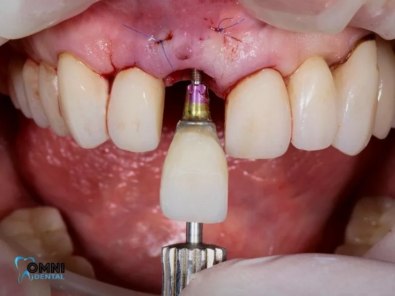 dental implant success rate smokers