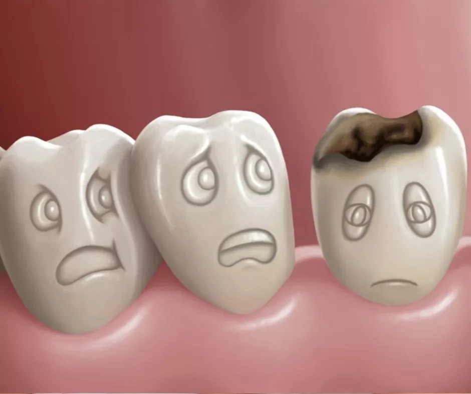 Can a Cavity Go Away On Its Own