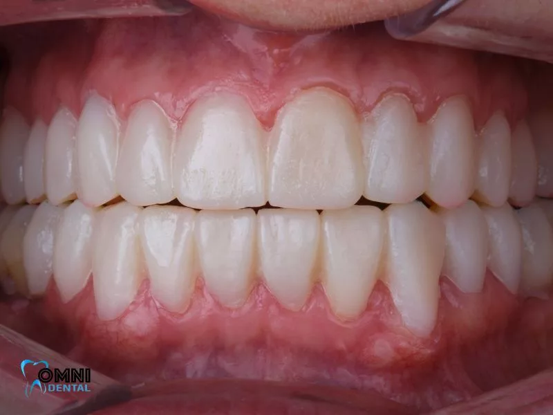 How to Maintain Oral Hygiene with a Temporary Filling