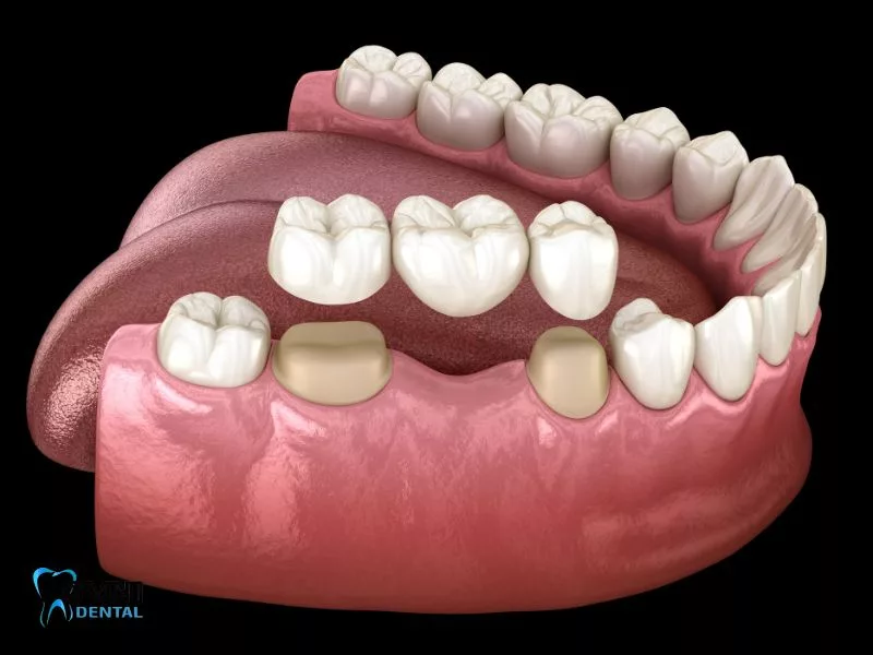 Top 5 Questions Patients Ask About Dental Bridges