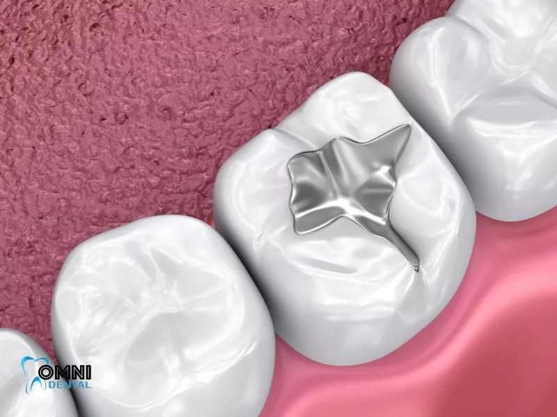 What material is used in dental fillings?