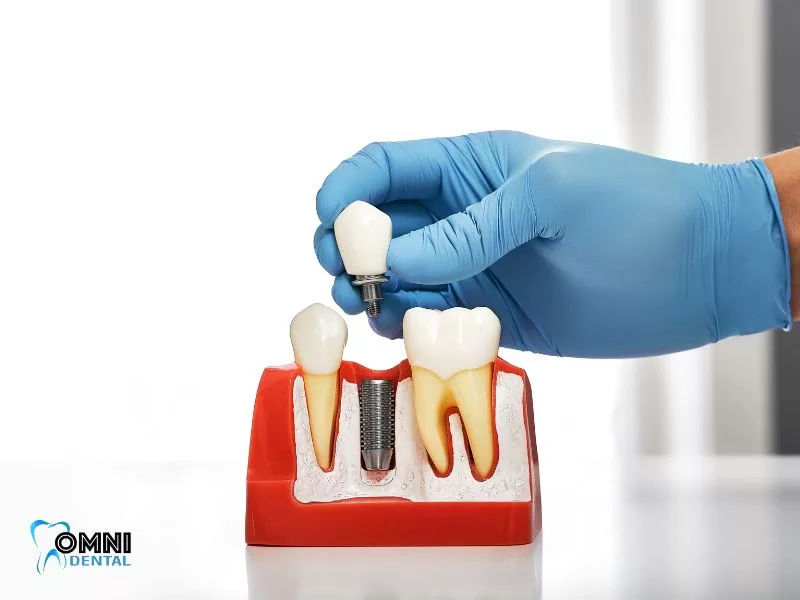 Navigating Through Dental Implant Difficulties