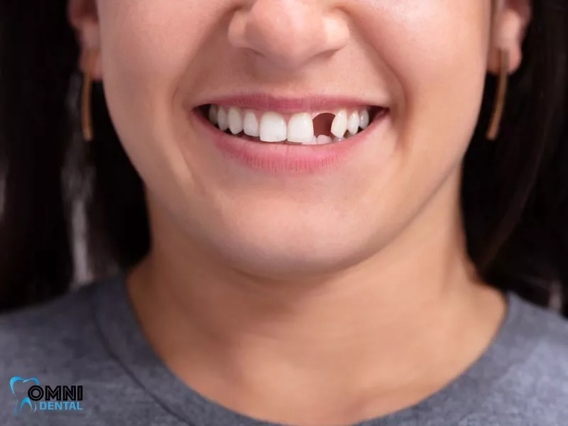 Factors Influencing the Longevity of Dental Implants