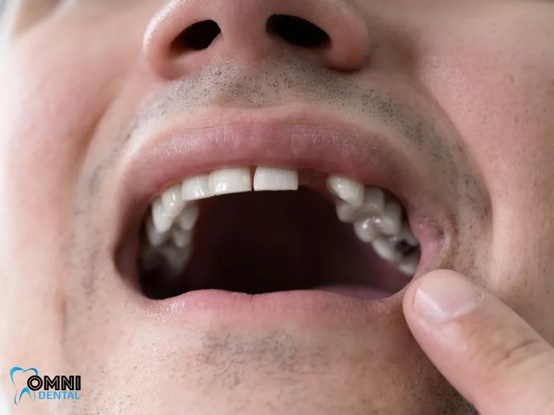 Concluding Thoughts on the Lifespan of Front Teeth Implants 
