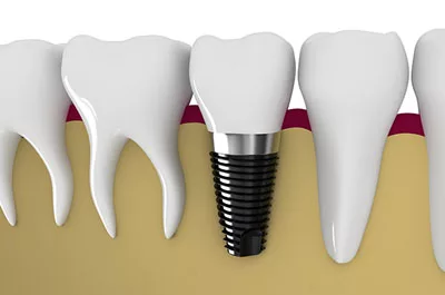 Crown placement options