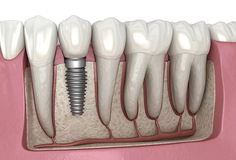 Is Uncovering Dental Implants Painful