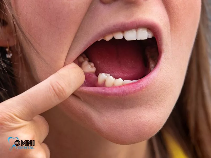Woman pulling back her cheek to show a gap from missing lower back teeth