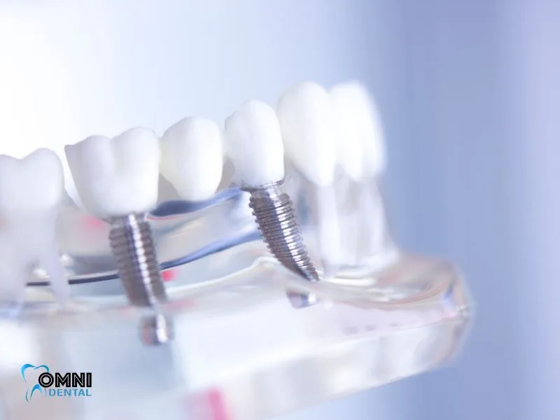 full arch of dental implants