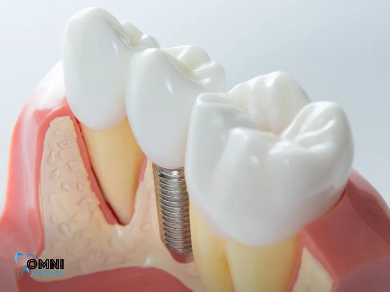full arch of dental implants