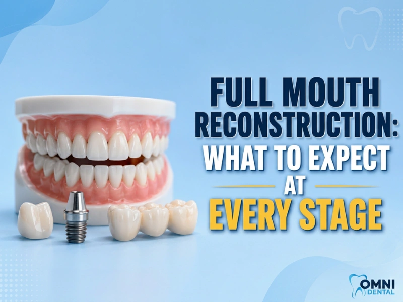 Full Mouth Reconstruction- What to Expect