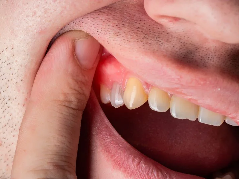 Gum Treatment – Arlington Heights – Omni Dental