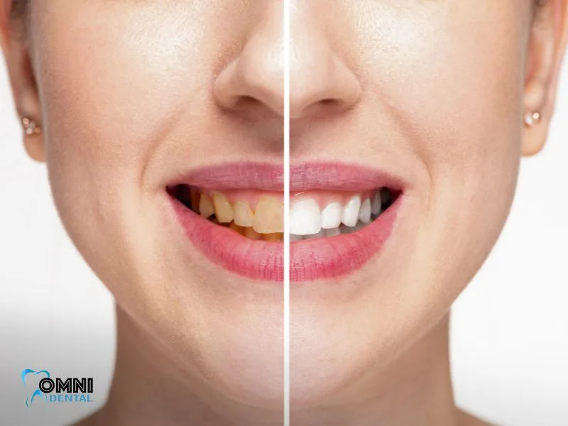 How Long Do Teeth Whitening Results Last?