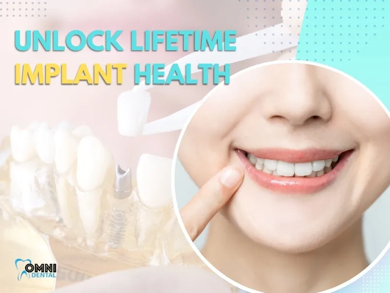 How to Maintain Dental Implants for Life