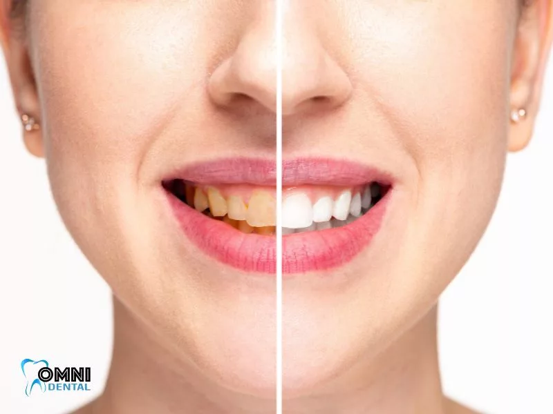 Teeth Whitening Arlington Heights, IL