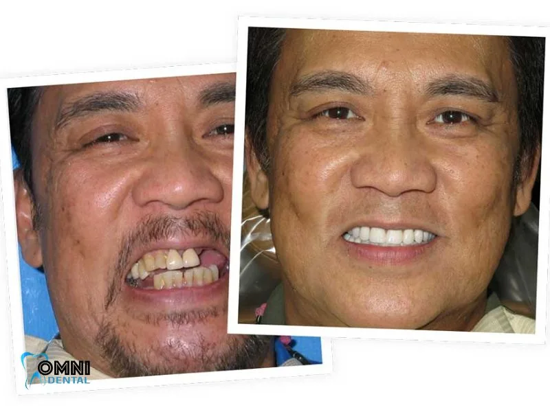 Choosing Between Dental Bonding and Veneers