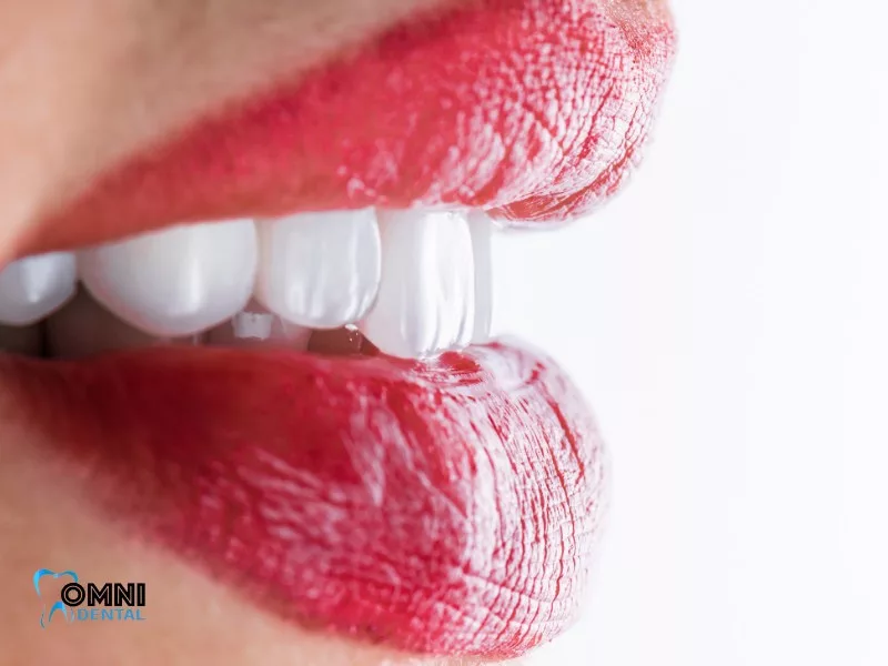 The Challenge of Staining with Porcelain Veneers