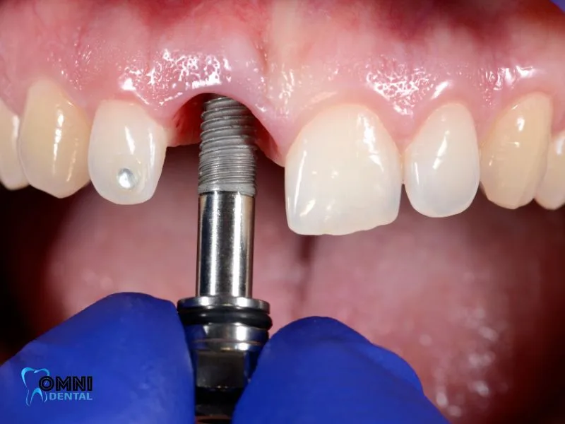 Tips for Long-Term Dental Implant Success