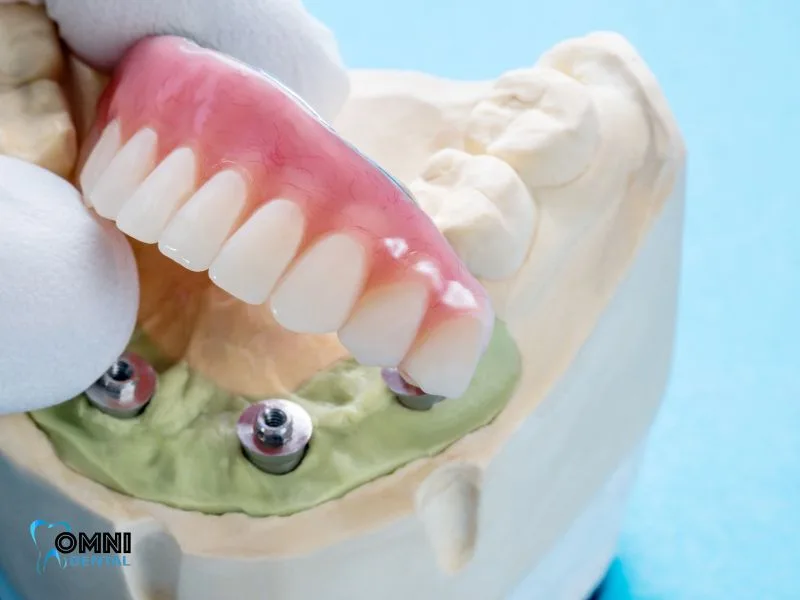 Tips For All-On-4 Dental Implant Patients