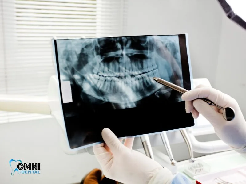 Common Early Signs of Oral Cancer