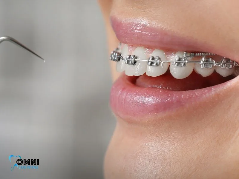 Treatment Options Including Braces, Aligners, and Surgery
