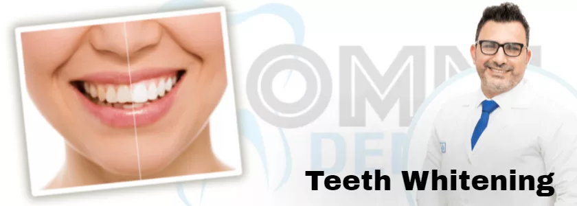 professional teeth whitening
