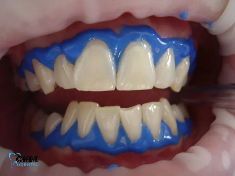 Teeth Whitening candidate