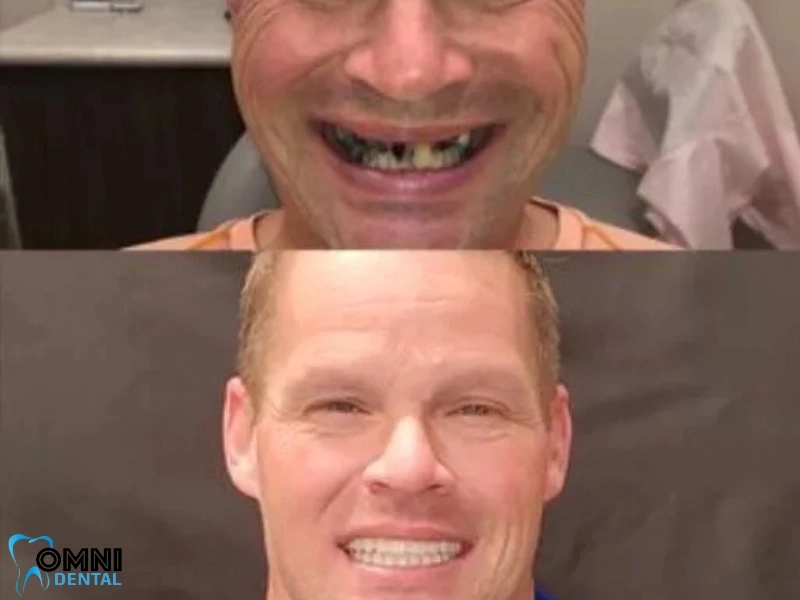 The Benefits of Dental Implants For the Front Teeth