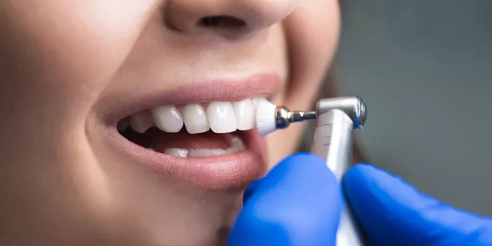 Dental professional polishing a patient's teeth during a cleaning