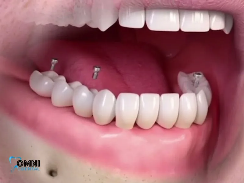 Understanding How Restorative Dentistry Works?