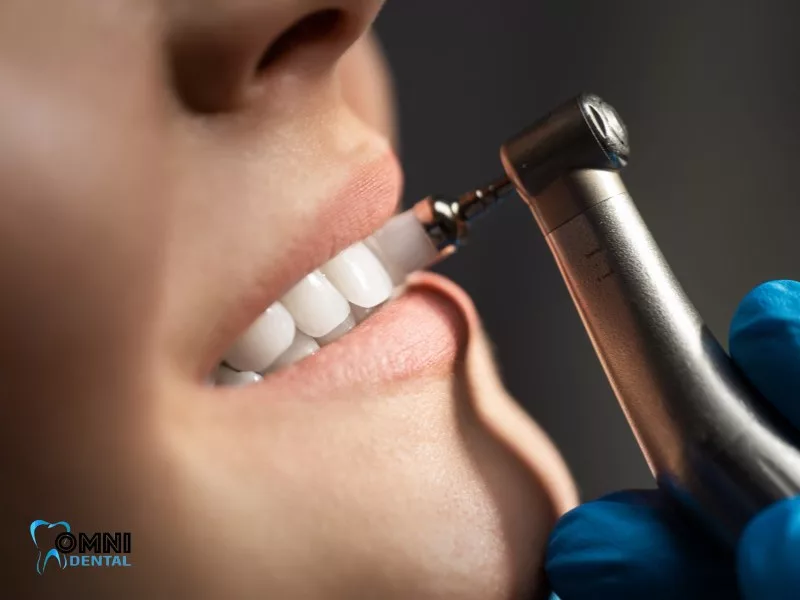 Porcelain Veneers: Candidacy, Cost, and Care Insights