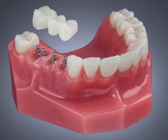 what are mini dental implants1