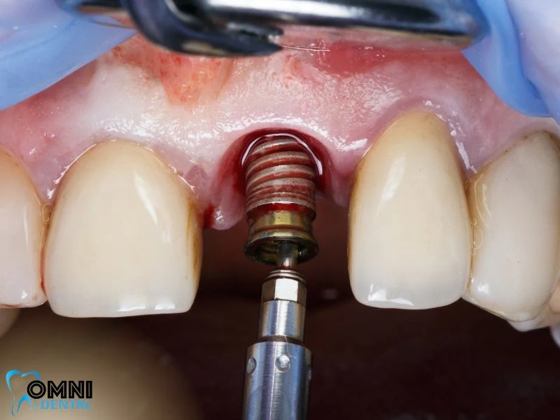 What is a Front Tooth Dental Implant