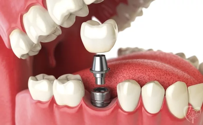 what is the best option for replacing missing teeth