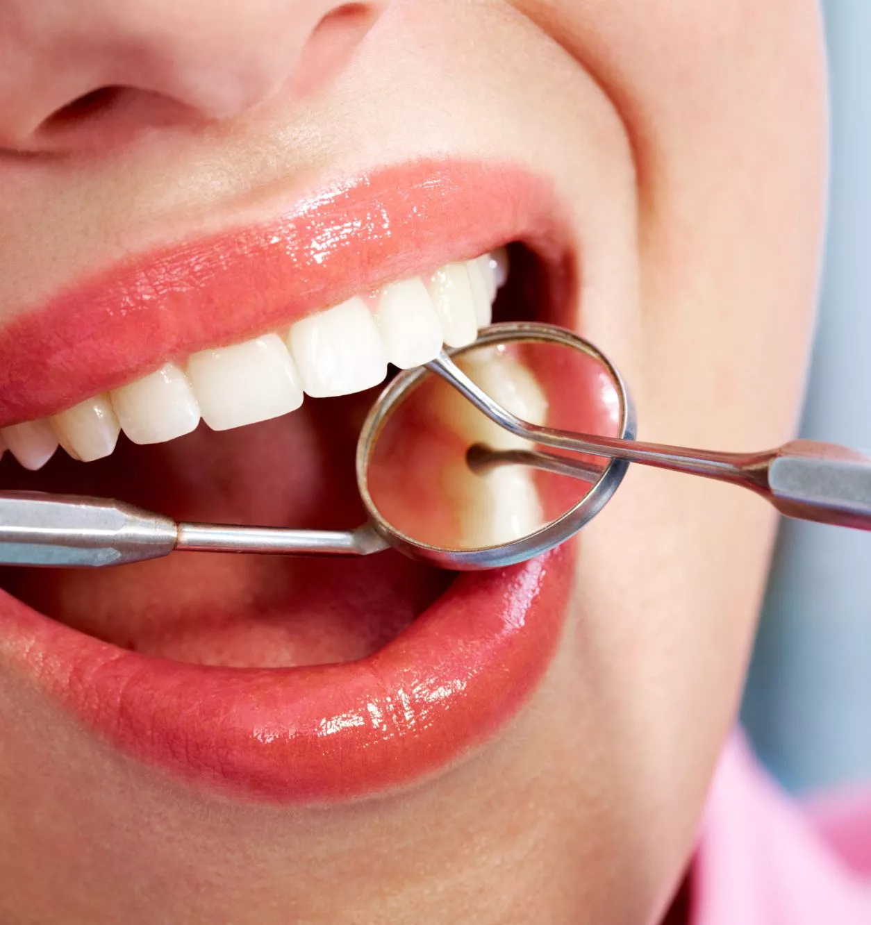 Benefits of Dental Bonding