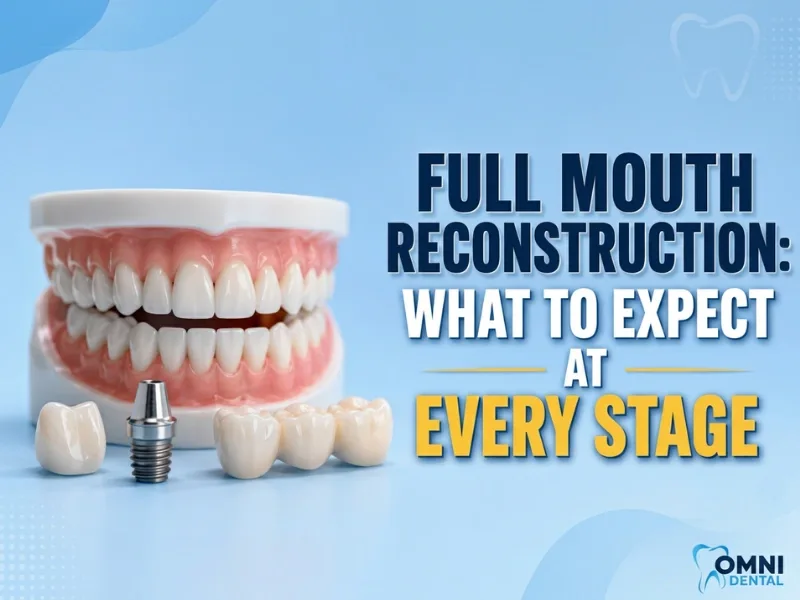 Full Mouth Reconstruction- What to Expect