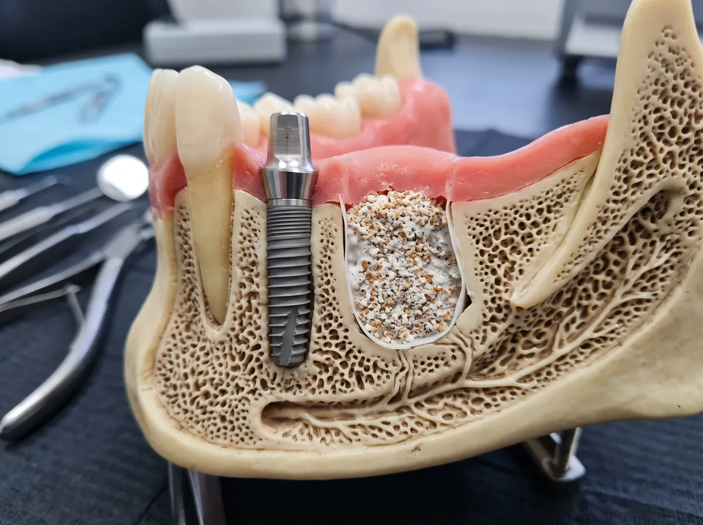 Not enough bone what grafting means for your plan at Omni Dental in Arlington Heights, IL