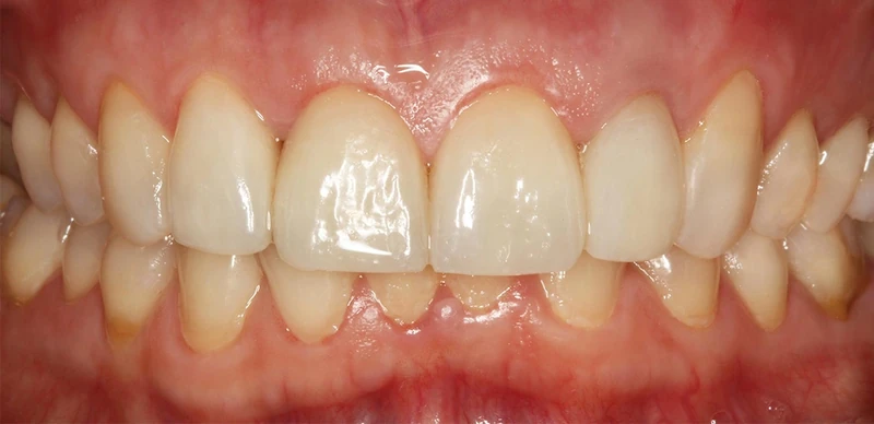 After front teeth restoration case 1: the same patient's teeth after treatment at Omni Dental