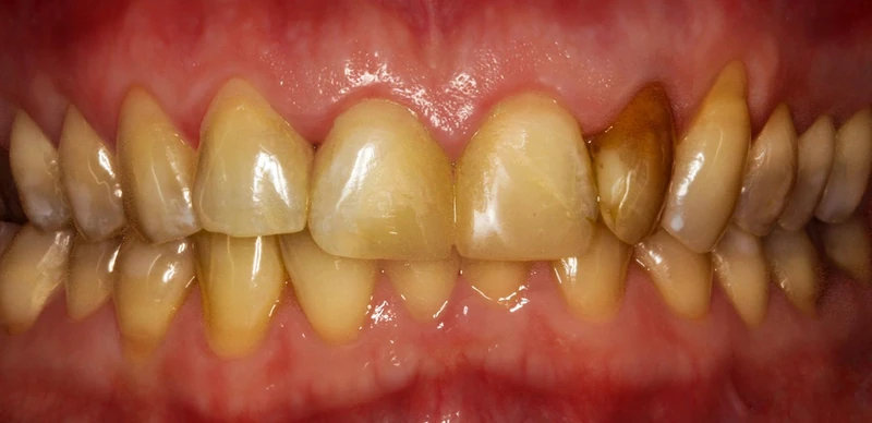 Before front teeth restoration case 1: an Omni Dental patient's teeth before treatment