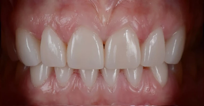 After front teeth restoration case 2: the same patient's teeth after treatment at Omni Dental
