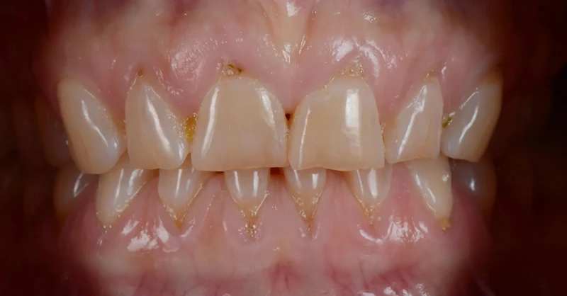 Before front teeth restoration case 2: an Omni Dental patient's teeth before treatment