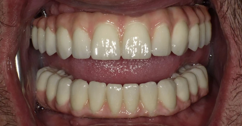 After full arch implant restoration: the same patient's teeth after treatment at Omni Dental