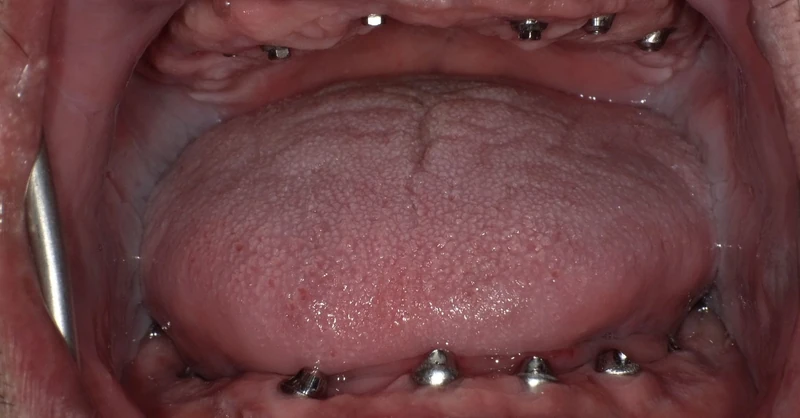 Before full arch implant restoration: an Omni Dental patient's teeth before treatment