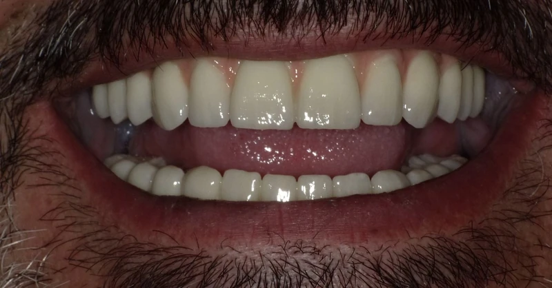 After full arch restoration case 1: the same patient's teeth after treatment at Omni Dental
