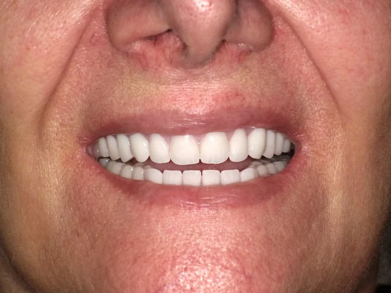 After full arch restoration case 2: the same patient's teeth after treatment at Omni Dental