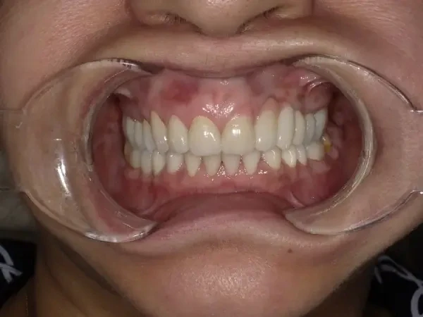 After smile restoration case 1: the same patient's teeth after treatment at Omni Dental