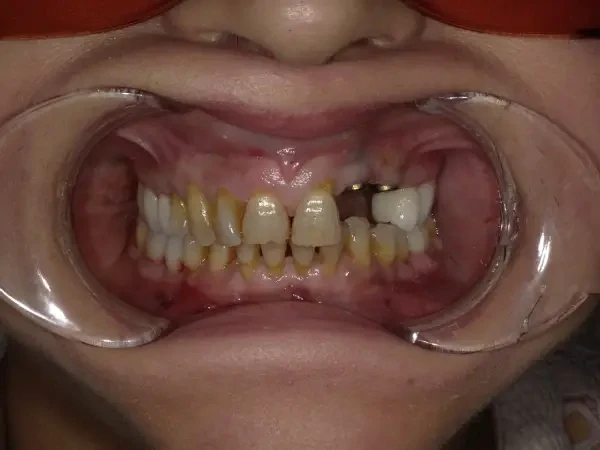 Before smile restoration case 1: an Omni Dental patient's teeth before treatment