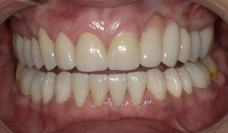 After smile restoration case 2: the same patient's teeth after treatment at Omni Dental