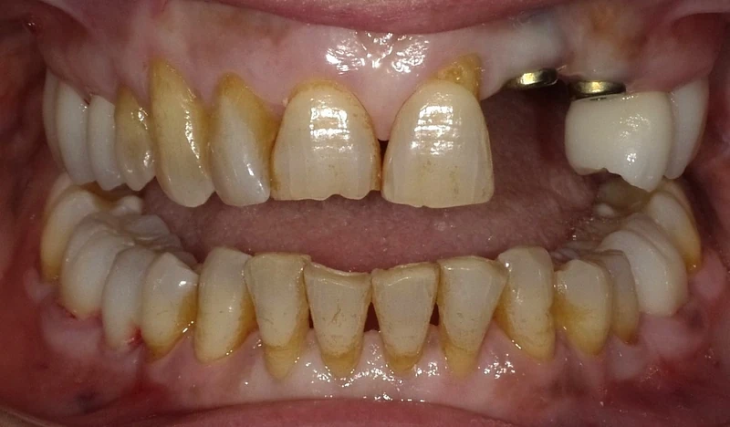 Before smile restoration case 2: an Omni Dental patient's teeth before treatment