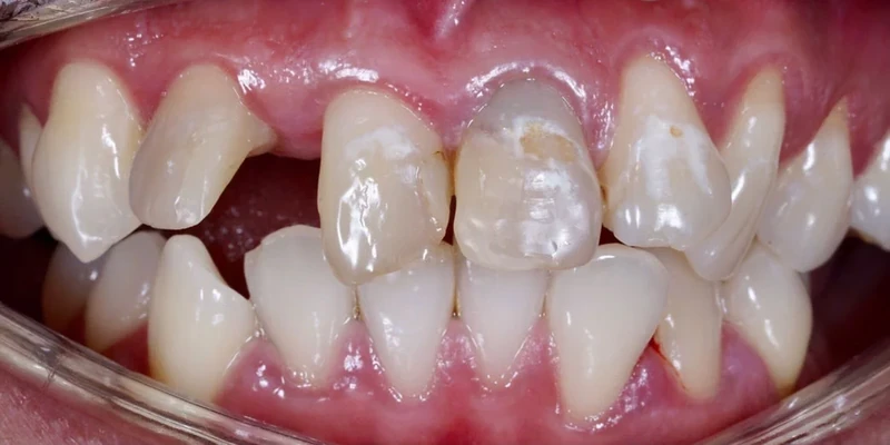 Before smile restoration case 4: an Omni Dental patient's teeth before treatment