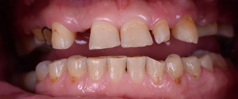 Before smile restoration case 5: an Omni Dental patient's teeth before treatment